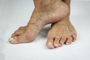 Artrite reumatoide deformazione dita dei piedi